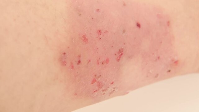 doctor applies ointment to wound from on lower leg with scars adult female patient, redness, sores on limbs, scarring skin, concept medical care, health care, human tissue regeneration