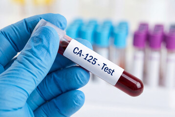 Fototapeta premium Medical professional holding CA 125 test blood sample tube