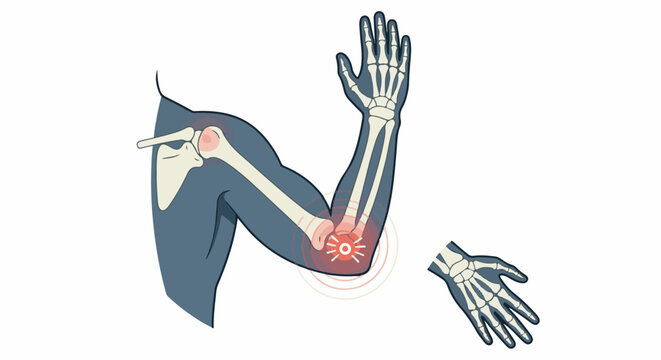 Anatomical illustration showing joint pain in human arm and hand