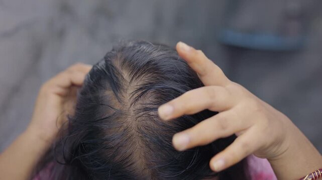 A woman showing her bald patches and thinning hair in indoor setting.