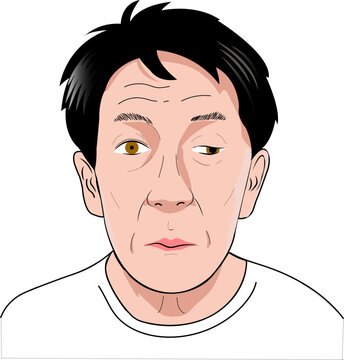 左側動眼神経麻痺（左眼瞼下垂、眼球の外転、瞳孔が大きい）のイラスト