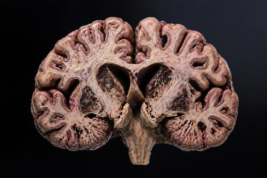 Coronal section of human brain showing striatal atrophy and enlarged ventricles, consistent with Huntington&rsquo;s disease