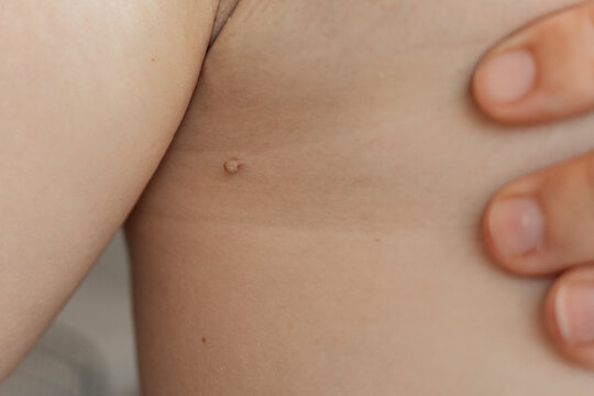 Large papilloma under the armpit of a woman. Mole big wart on skin woman. Concept dermatology body diseases papilloma or melanoma, Oncology malignant tumor.