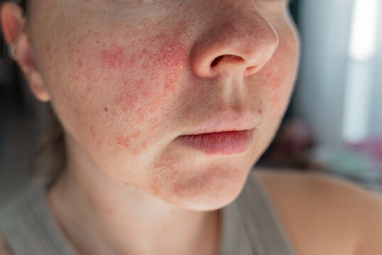 Close-up of a young womans face with visible skin irritation and redness. Inflamed, dry, and textured skin. Concept of sensitive skin, allergy, inflammation, and skincare problems