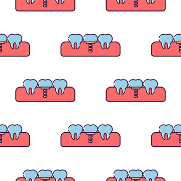 Dental implant process illustration showing tooth replacement isolated on transparent background