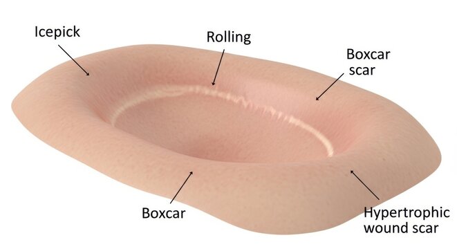 Illustration of different types of acne scars on skin, including icepick, rolling, boxcar, and hypertrophic wound scars
