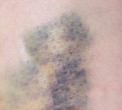 Close up purple bruise on skin. Bruise from impact. Bruising and hematoma on human body