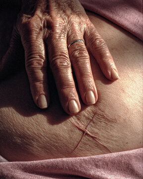Elderly hand gently resting on abdomen with visible c section scar, showing healing process and resilience, soft natural light, emotional and intimate moment