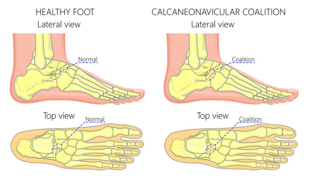 Normal foot and a foot with calcaneonavicular coalition