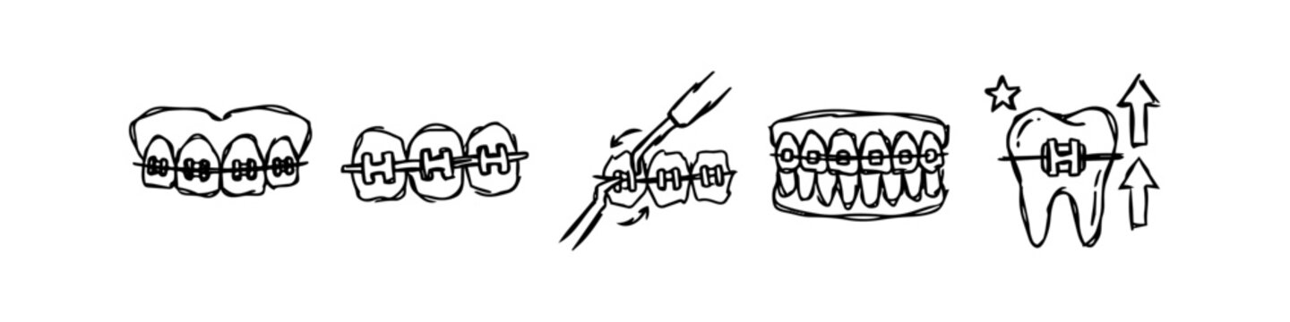 Hand-drawn doodle set of dental braces and orthodontic procedures on teeth. Minimalist black and white sketches illustrating teeth straightening and dental care icons.