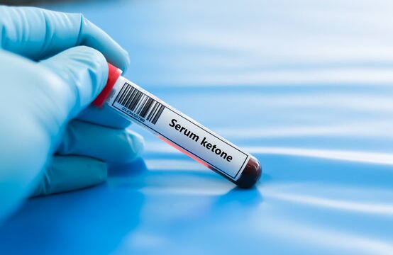 Blood sample tube for serum ketone test analysis.