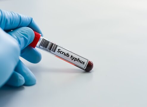 Blood sample tube for scrub typhus test analysis.