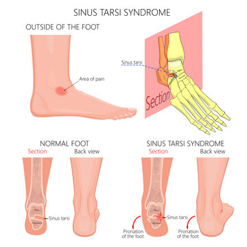 Sinus tarsi syndrome