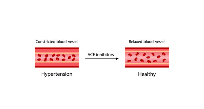 ACE inhibitors. Renin-Angiotensin-Aldosterone System, blood pressure regulation. Hypertension, Constricted and relaxed blood vessel. Vasoconstriction and vasodilatation. Vector illustration.