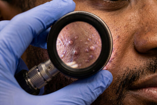 Macro dermatoscope view of acne vulgaris on dark skin