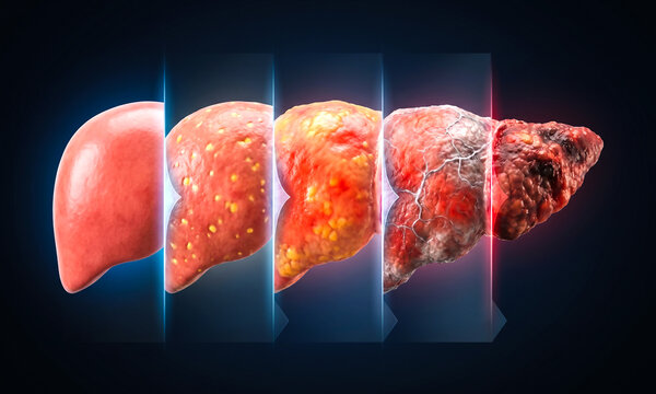 A liver's journey from health to severe damage is visually segmented.