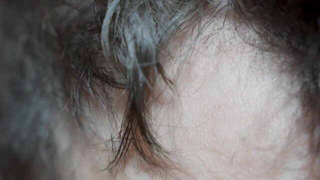 hair thinning crown close up, male hair loss concept for dermatology and treatment advertising