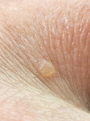 Fototapeta premium close up of human skin, papilloma, verruca