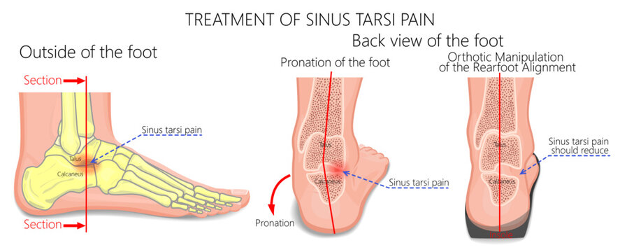 Sinus tarsi syndrome pain reduction. Orthotic Manipulation of the Rearfoot Alignment
