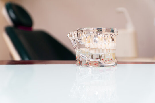 Dental jaw model showing teeth and implants in clinic