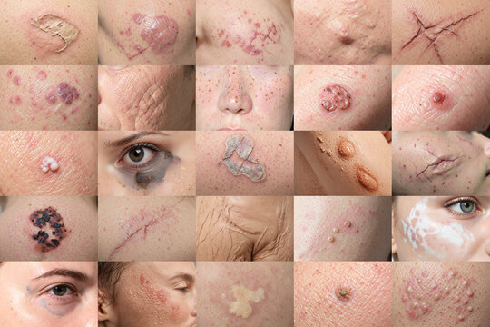Common skin problems and dermatological conditions set, ai generated. Different infection or oncology skinproblem with nevus, vitiligo, cracked, redness concept. Facial dermatology diagnosis.