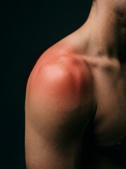 Fototapeta premium Close-up of Man's Shoulder with Prominent Red Inflammatory Marking Representing Pain