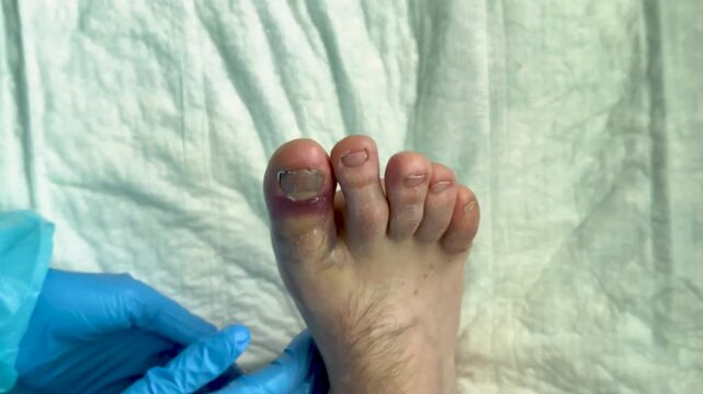 Medical professional examines injured toe with visible swelling and discoloration, wearing blue gloves, on a white examination table in a clinical setting