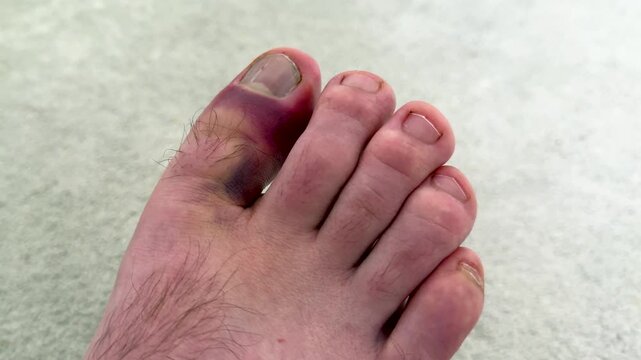 Male foot with visible hematoma on the big toe, showing progression of bruising and discoloration in close-up view against a light background