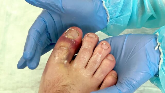Medical professional examines foot with visible broken capillaries, wearing blue gloves, in a clinical setting with a focus on the toes and surrounding area