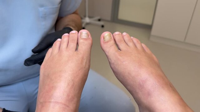 Feet with damaged toenails and podologist in background, foot care concept