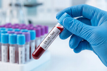 Fototapeta premium Doctor holds a blood sample tube for a CA 125 cancer marker test in a medical lab
