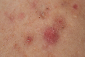 Fototapeta premium Macro shot of skin irritation with acne. Dermatology concept with acne skin pores. Skin rash texture with acne. Irritated acne skin.