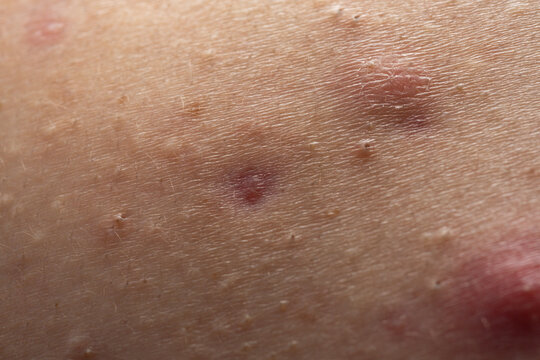 Close up acne on skin. Inflamed skin bumps acne macro. Irritated skin with pimples acne texture. Detailed skin with acne.