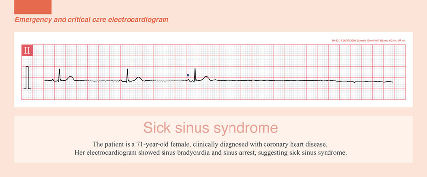 The patient is a 71-year-old female, clinically diagnosed with coronary heart disease. Her electrocardiogram showed sinus bradycardia and sinus arrest, suggesting sick sinus syndrome.
