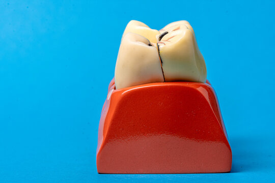 Molar tooth model showing decay and dental disease