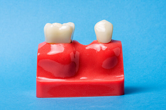 Dental model demonstrating missing tooth and prosthetic replacement