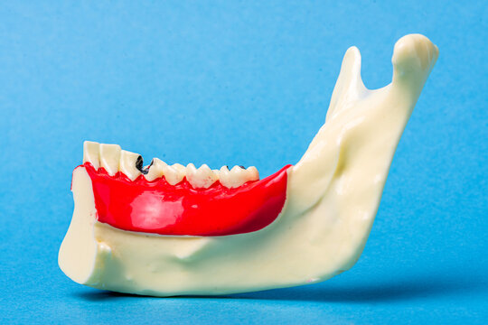 Dental anatomy model showing tooth decay and gingivitis