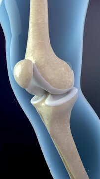3D animation: how rheumatic osteoarthritis develops in the knee joint. Repair and therapy for painful knee, reducing inflammation and regenerating cartilage. Medical visualization.