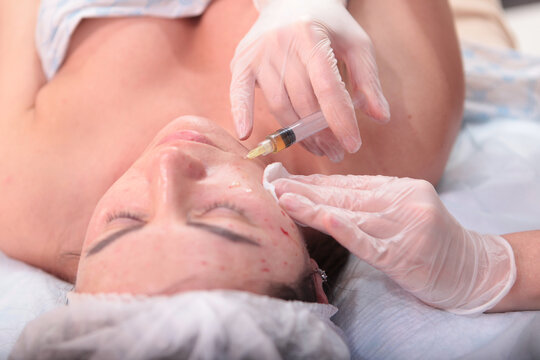 Plasmolifting procedure. Cosmetologist makes injections of plasmolifting. Blood in test tube. Close-up of patient's face is out of focus. Selective focus. Concept of cosmetology