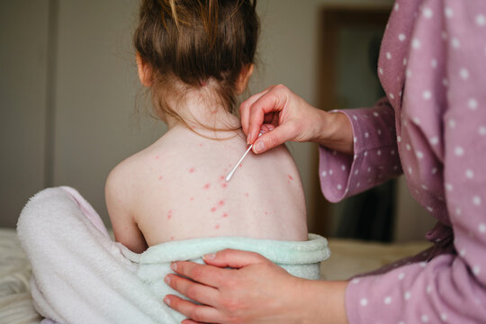 Mother applying gel treatment to child with chickenpox indoors