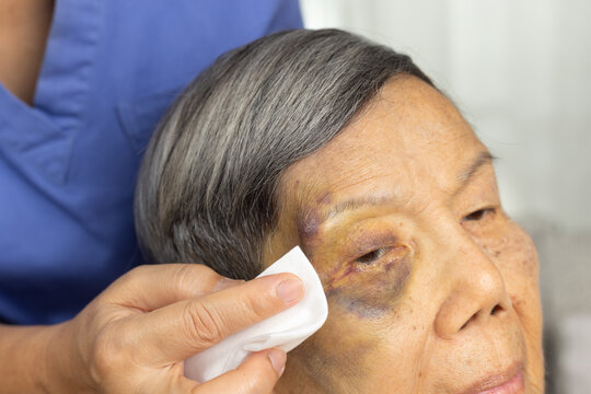 Caregiver apply a warm compress to the bruise elderly woman eyebrow and a black eye.