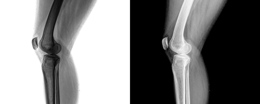 Clinical Knee Joint Lateral X-ray Showing Bone Alignment for Arthritis Evaluation Isolated on Transparent Background