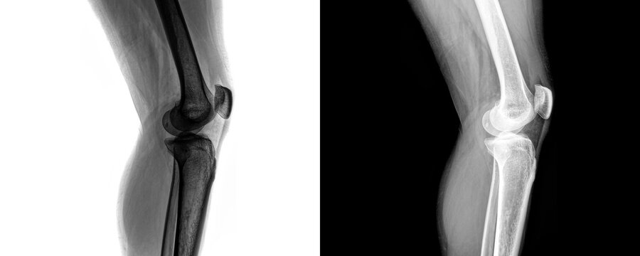 Medical Knee Joint Lateral View X-ray Showing Joint Alignment and Degeneration for Arthritis Assessment Isolated on Transparent Background