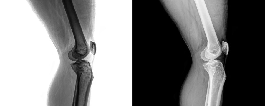 Knee Joint Lateral Radiograph Showing Femur, Tibia, Patella for Arthritis Evaluation Isolated on Transparent Background