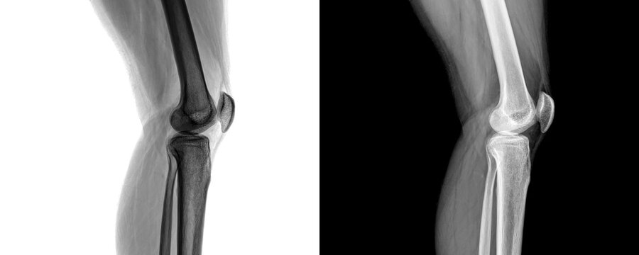 Diagnostic Knee Joint Lateral X-ray Showing Joint Space Narrowing for Arthritis Detection Isolated on Transparent Background