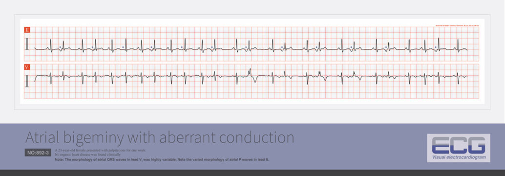 A sinus beat and an atrial premature beat alternate. The QRS complex of premature atrial contractions is accompanied by varying degrees of iintraventricular aberrant conduction.
