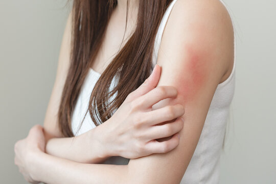 Close-up of young woman scratch her arm have a red rash