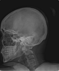 Side projection of a human head bone structure displaying the mandible, maxilla, and cervical spine. © RadVisuals