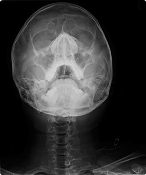 Frontal diagnostic imaging of the human facial skeleton displaying the sinuses and upper cervical spine alignment.