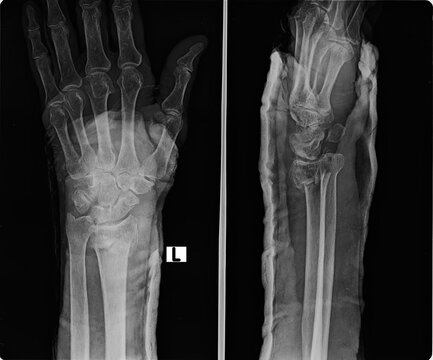 Diagnostic medical imaging of a human arm bone structure showcasing a fracture of the distal forearm.